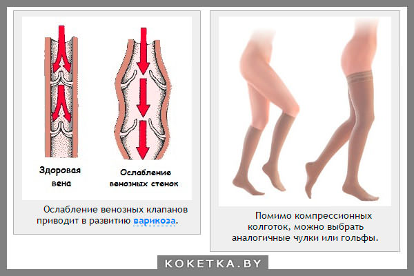 Варикозное расширение вен при беременности