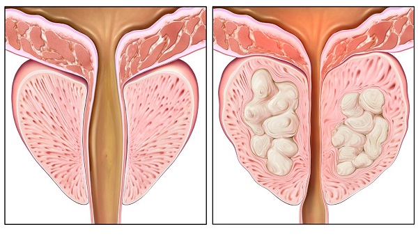 Простатит, лечение дома и у врача