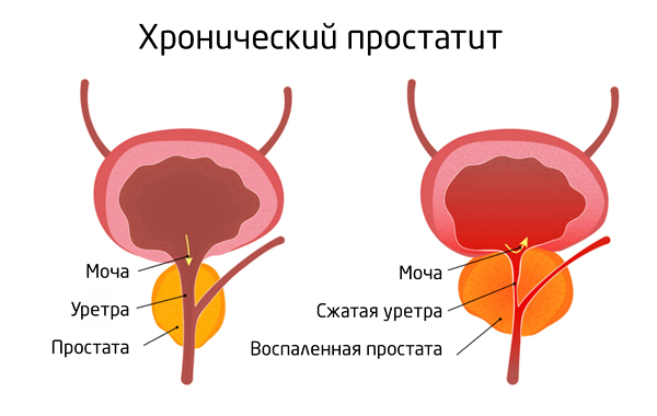 Острый и хронический простатит