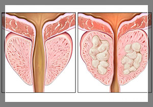 2769 prostatit lechit