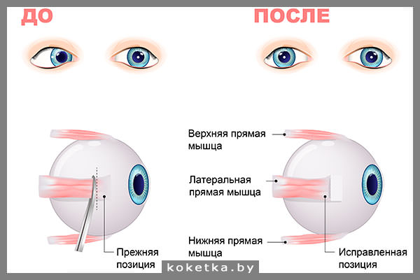 Операция для исправления косоглазия
