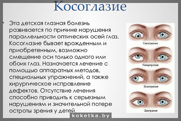 Определение косоглазия