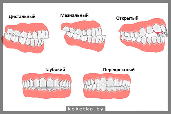 Неправильный прикус: виды