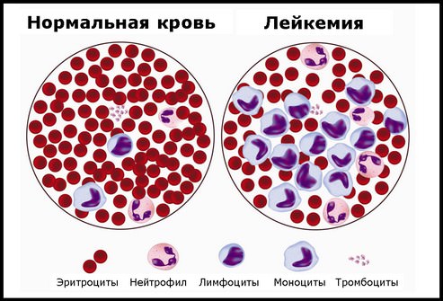 Лейкоз у детей: причины, симптомы, диагностика  болезни