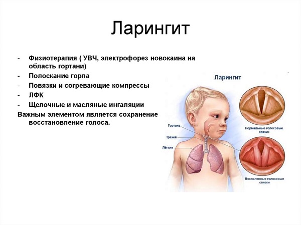 Что такое ларингит?