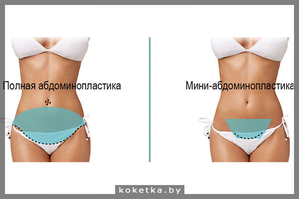 Виды пластики живота
