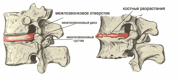 Остеохондроз: сдавливание межпозвоночных дисков