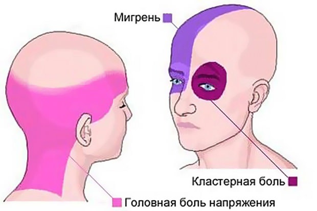 3 вида головной боли и места её локализации