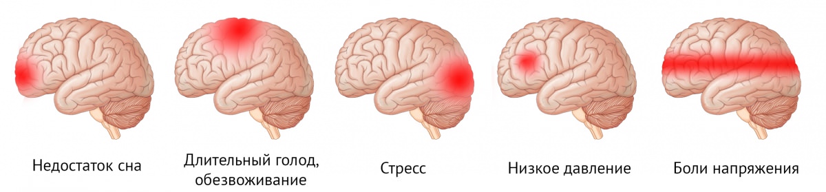 Локализация головной боли