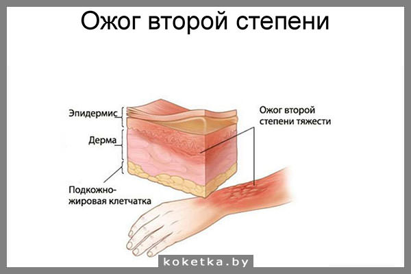 Ожог второй степени (схематическое изображение) 