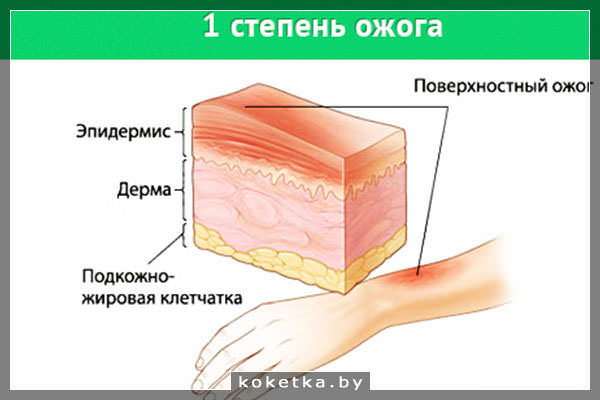 Ожог 1 степени (схематическое изображение)