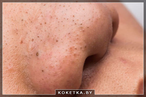 черные точки на лице 
