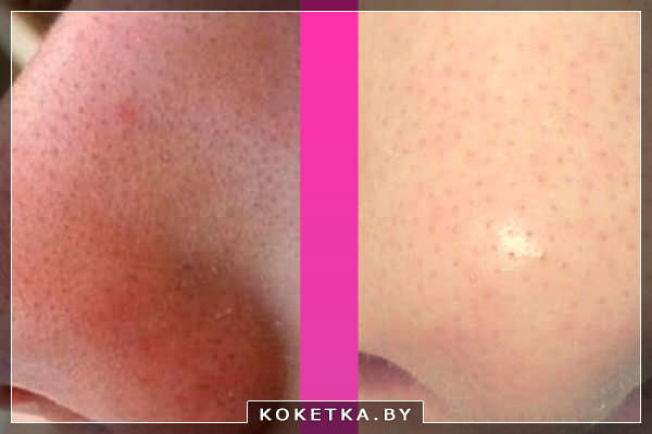 черные точки на лице устранить