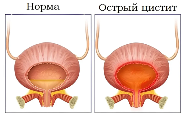 Цистит