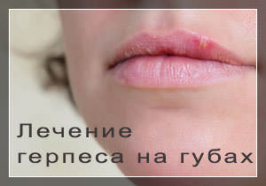 Быстрое лечение герпеса на губах